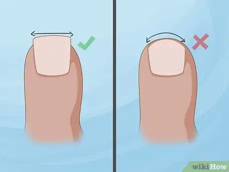 Image titled Prevent Ingrown Nails Step 1