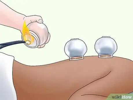 Image titled Do Cupping Step 1