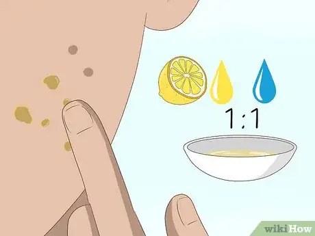 Image titled Get Rid of Acne Scars Fast Step 11
