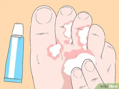 Image titled Stop Itching Caused by Athlete's Foot Step 1