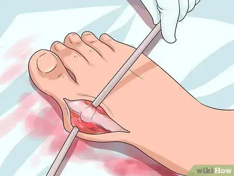 Image titled Get Rid of Bunions Step 11