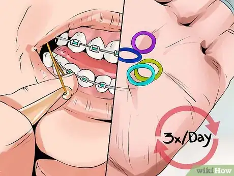 Image titled Connect a Rubber Band to Your Braces Step 8