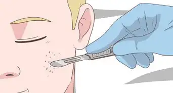 Get Rid of Acne Cysts Fast