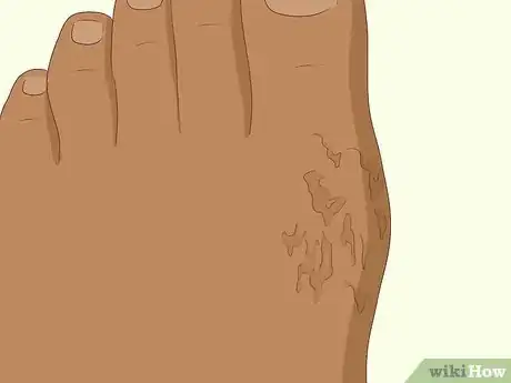 Image titled Recognize Gout Symptoms Step 6