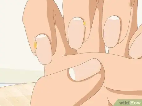 Image titled Heal Cuticles Step 1