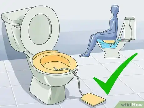 Image titled Get Rid of External Hemorrhoids Fast Step 1