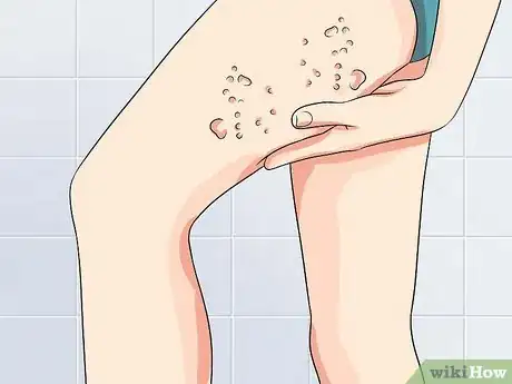 Image titled Ease Herpes Pain with Home Remedies Step 35