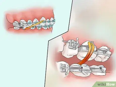 Image titled Connect a Rubber Band to Your Braces Step 5