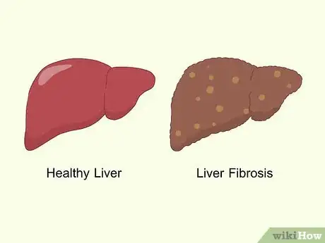 Image titled Treat Liver Fibrosis Step 1