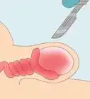 Treat Pain and Swelling in the Testicles