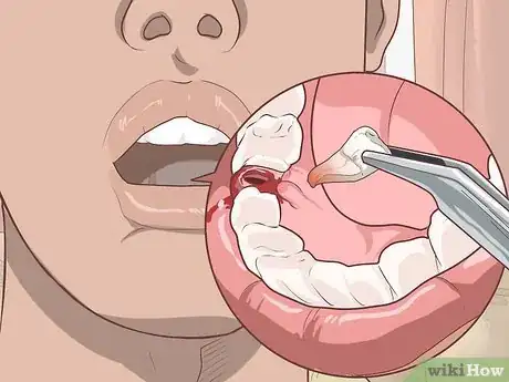 Image titled Prepare for Tooth Extraction Step 1