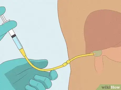 Image titled Get Rid of Gallstones Step 13