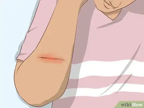 Image titled Quickly Treat a Cut or Bleeding Scrape Step 10