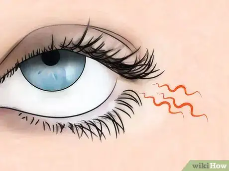 Image titled Know if You Have Eye Mites Step 2