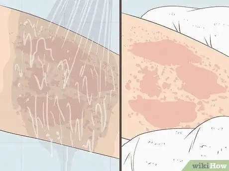 Image titled Get Rid of a Rash Step 2