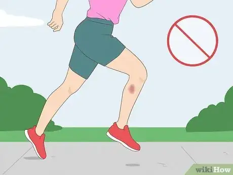 Image titled Get Rid of Bruises with Toothpaste Step 9