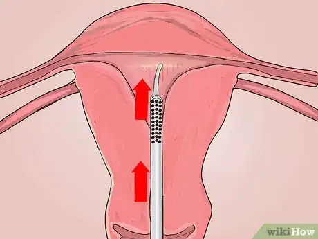 Image titled Decide if You Need a Hysterectomy Step 17