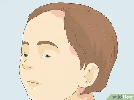 Image titled Make Your Scalp Stop Itching Step 14