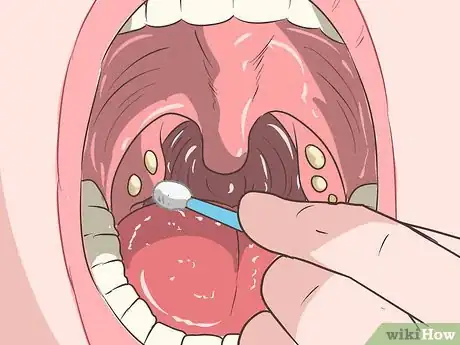 Image titled Remove Tonsil Stones (Tonsilloliths) Step 5