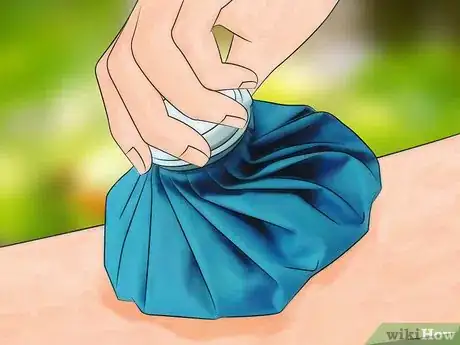 Image titled Get Bug Bites to Stop Itching Step 1