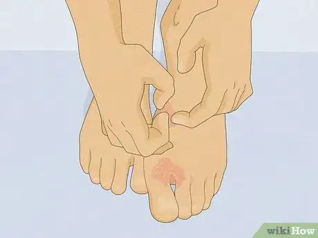 Image titled Treat and Prevent Athlete's Foot Step 8