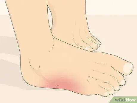 Image titled Know if You Have Neuropathy in Your Feet Step 3