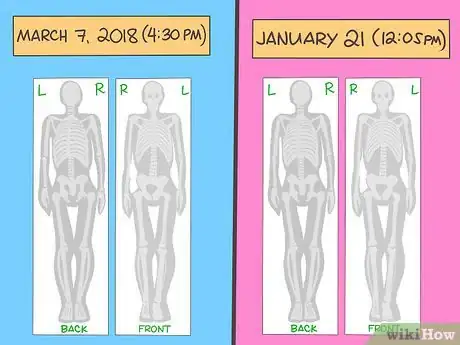 Image titled Understand the Results of a Bone Scan Step 4