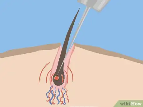 Image titled Remove Stomach Hair Step 7