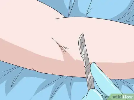 Image titled Treat Elbow Bursitis Step 8