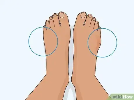 Image titled Heal a Toe Injury Step 4