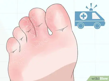 Image titled Treat Itchy Feet Caused by Diabetes Step 10