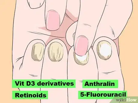 Image titled Get Rid of Psoriasis on Your Nails Step 3