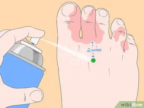 Image titled Stop Itching Caused by Athlete's Foot Step 3