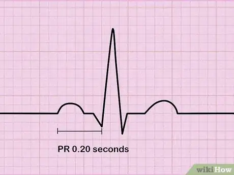 Image titled Read an EKG Step 4