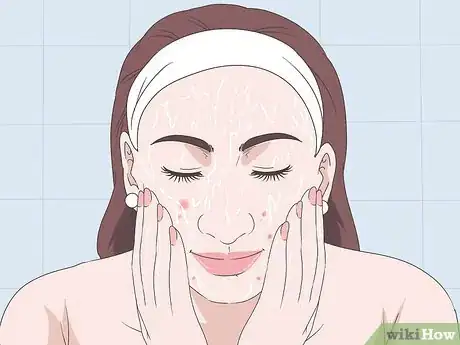 Image titled Treat Papule Acne Step 2