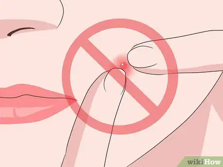 Image titled Stop a Pimple from Forming Step 1