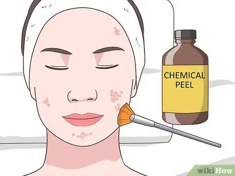 Image titled Get Rid of Acne Cysts Fast Step 20