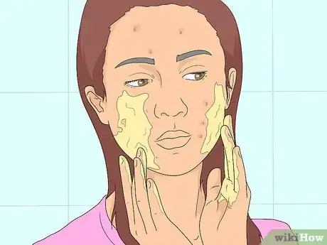 Image titled Treat Acne with Apple Cider Vinegar Step 10