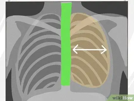 Image titled Know if a Chest X Ray Film Is Rotated Step 3