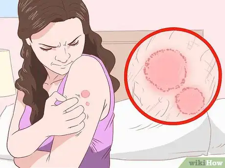 Image titled Prevent Skin Fungus Step 10