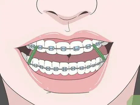 Image titled Eat Food With New or Tightened Braces Step 12