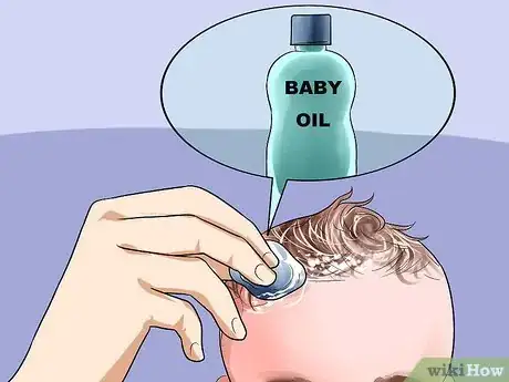 Image titled Easily Clean Baby's Cradle Cap Dandruff Without Hurting the Baby Step 1