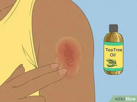 Image titled Get Rid of a Rash Step 7