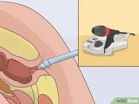 Image titled Stop Bleeding Hemorrhoids Step 10