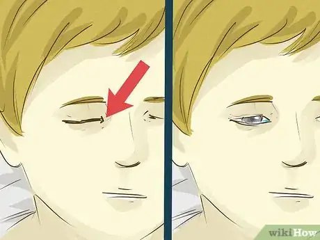 Image titled Use Eye Drops Step 29