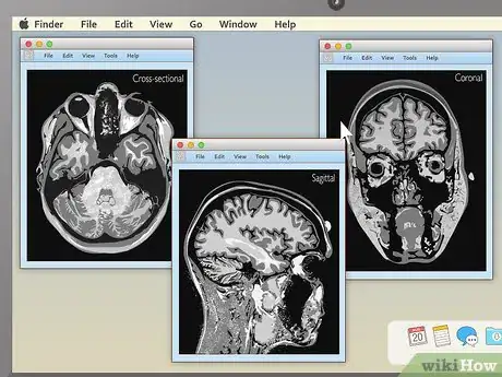 Image titled Read an MRI Step 6