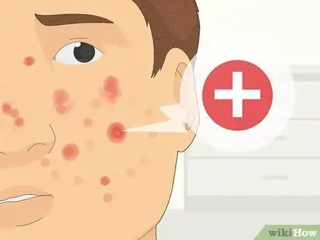 Image titled Get Rid of a Pimple Step 13