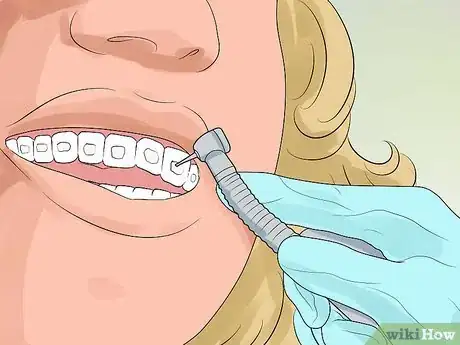 Image titled Prepare for Getting Braces Removed Step 7