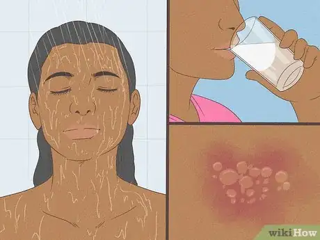 Image titled Get Rid of a Rash Step 8