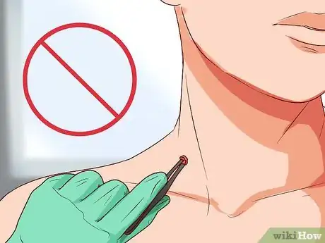 Image titled Get a Skin Tag Removed by a Doctor Step 12